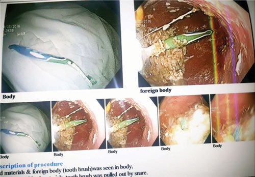 بلعیدن مسواک توسط  دختر قزوینی و خارج کردن آن از معده  دختر جوان!+ عکس
